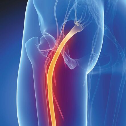 Person with sciatica pain radiating down the leg